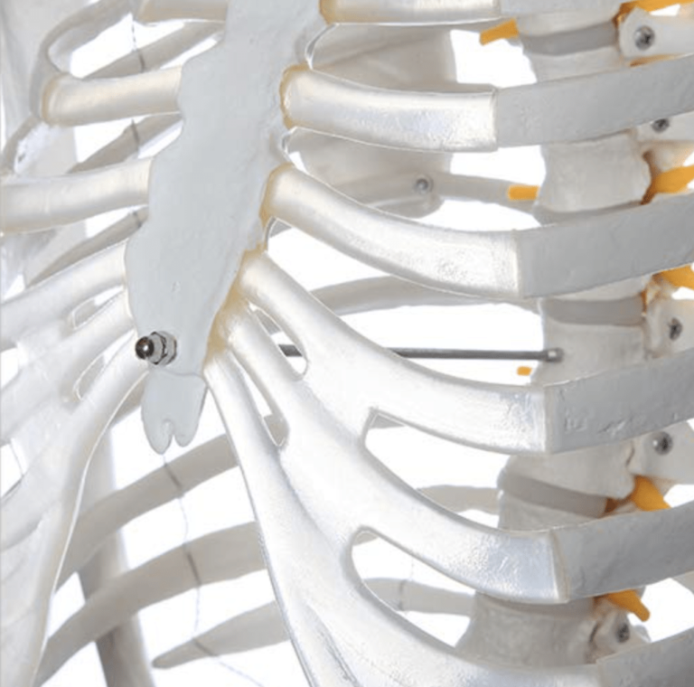 Hypermobility Rib Subluxation A Practical Guide The Fibro Guy