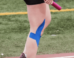 KT tape on a hypermobile knee