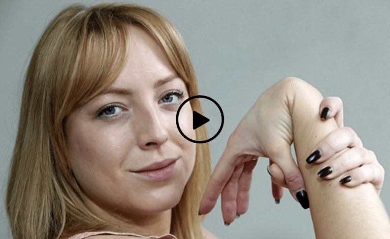 A woman with Ehlers Danlos showing how lax her wrist ligaments are by bending her thumb to her wrist