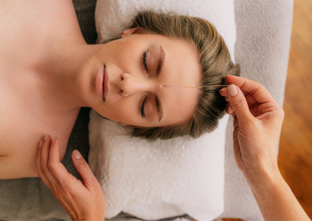 A woman receiving acupuncture