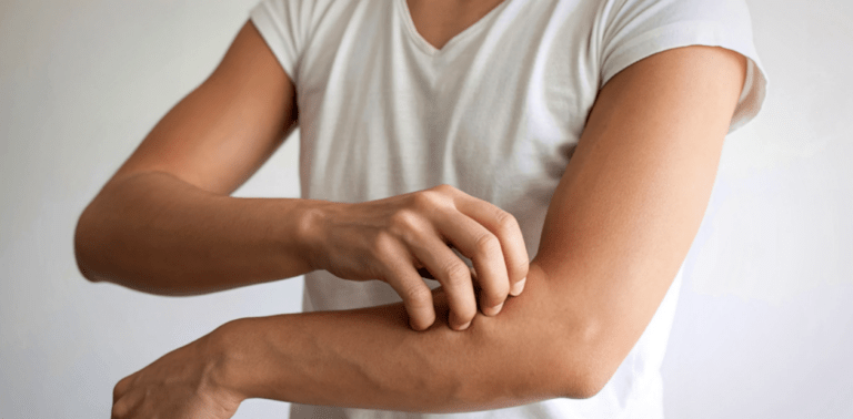 A woman with fibromyalgia, wearing a white t shirt, itching her arm